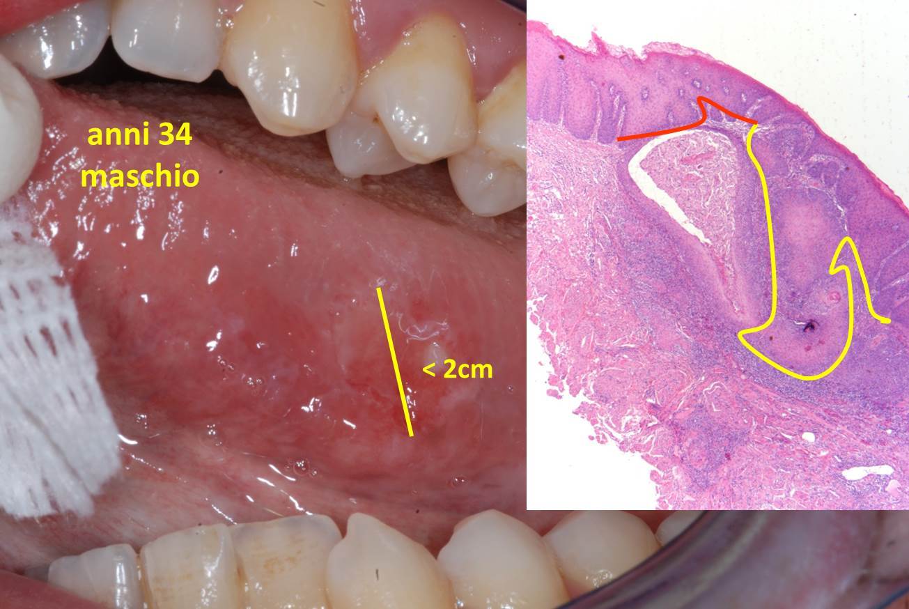 Carcinoma Del Cavo Orale Patologia Orale