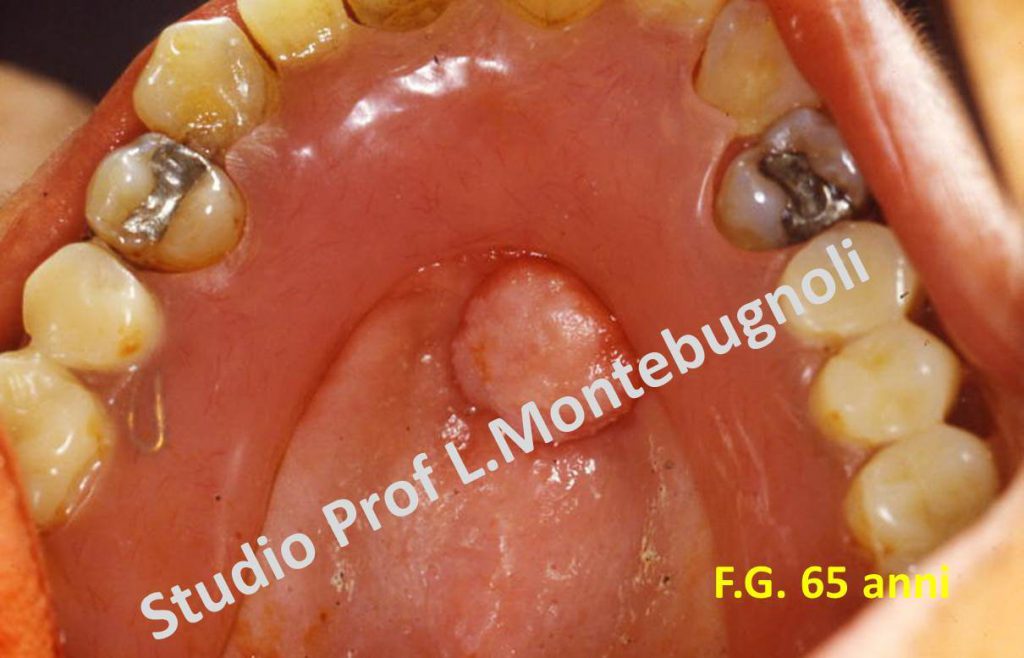 Carcinoma Del Cavo Orale Patologia Orale